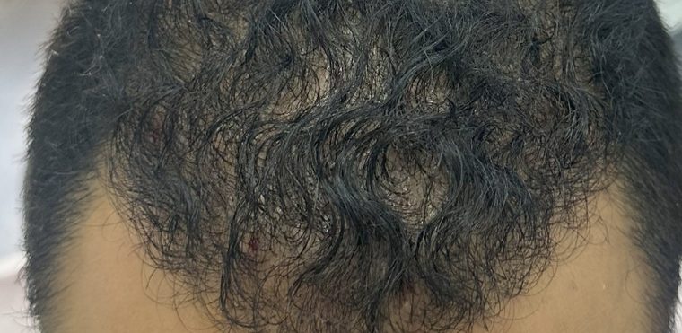 بعد: تغطية كاملة لمنطقة التاج